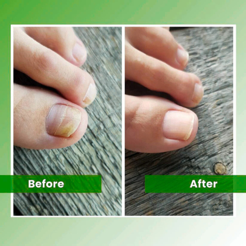 Growvy™ - Nail Fungus Laser
