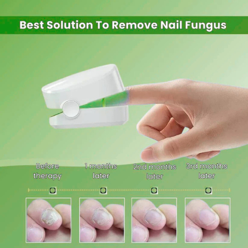 Growvy™ - Nail Fungus Laser